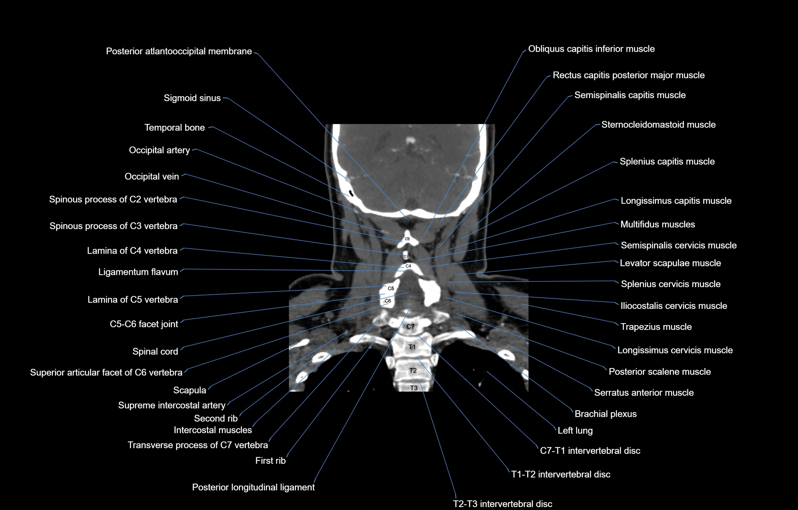CT Neck coronal  cross sectional anatomy labelled 3D  radiology  image-00049.webp